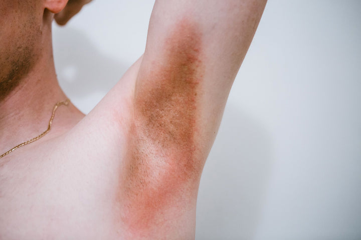 Harms of Using Traditional Hyperhidrosis Treatments